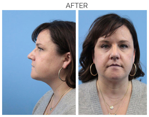 After chin liposuction