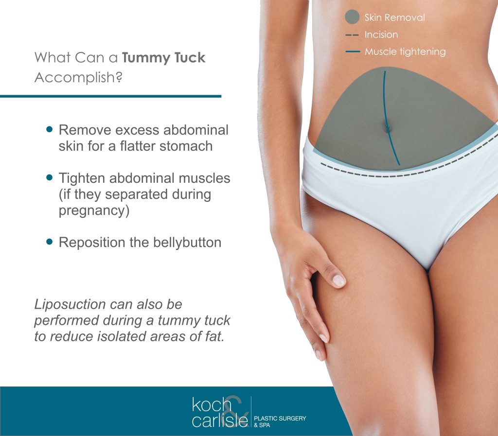 Things a tummy tuck can accomplish, remove excess abdominal skin for a flatter stomach, tighten abdomincal muscles, and reposition the bellybutton