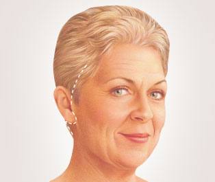  A traditional facelift incision begins in the hairline and extends behind the ear. 