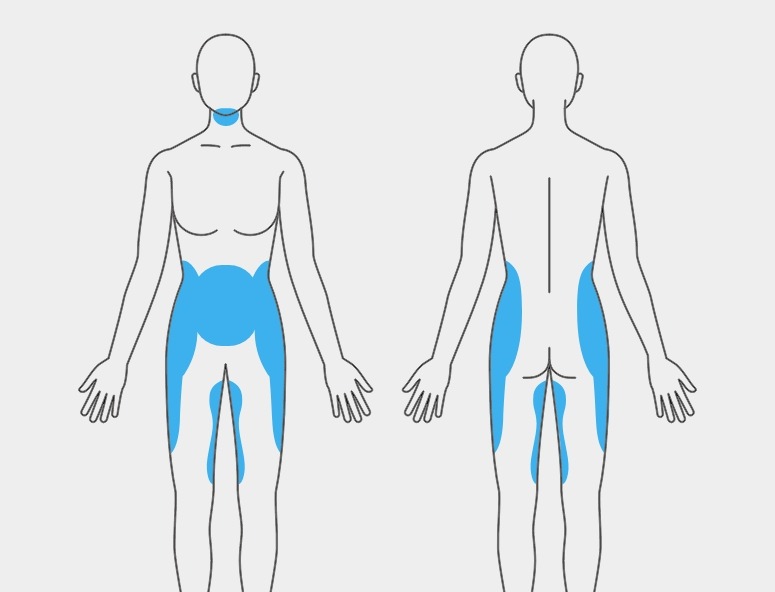 Coolsculpting treatment areas