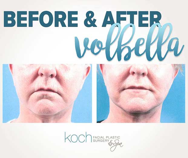 Before and after Volbella