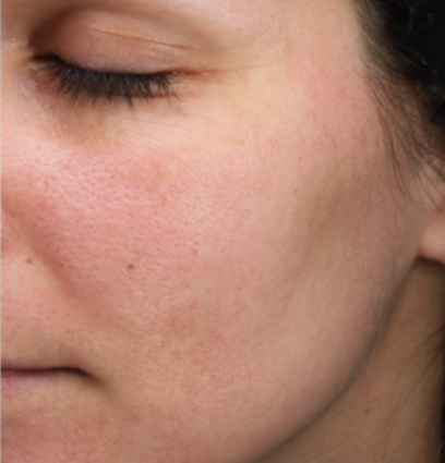 woman's face after moxi treatment
