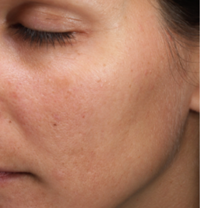 woman's face before moxi treatment