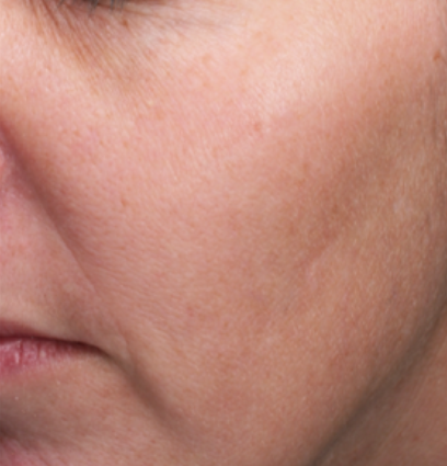 woman's face after 3 moxi treatments