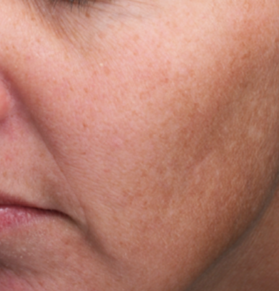 woman's face before moxi treatment