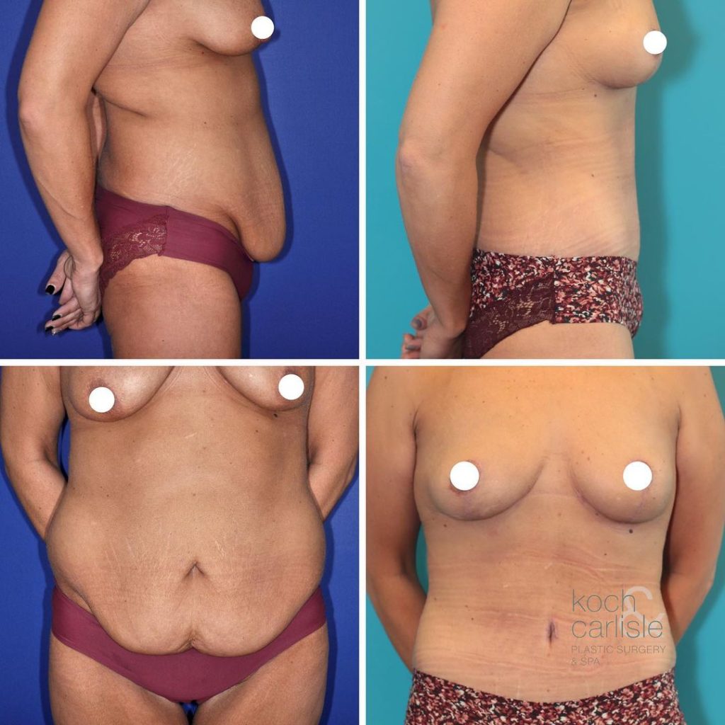 Before and after tummy tuck and breast lift surgery with Dr. Michael Carlisle
