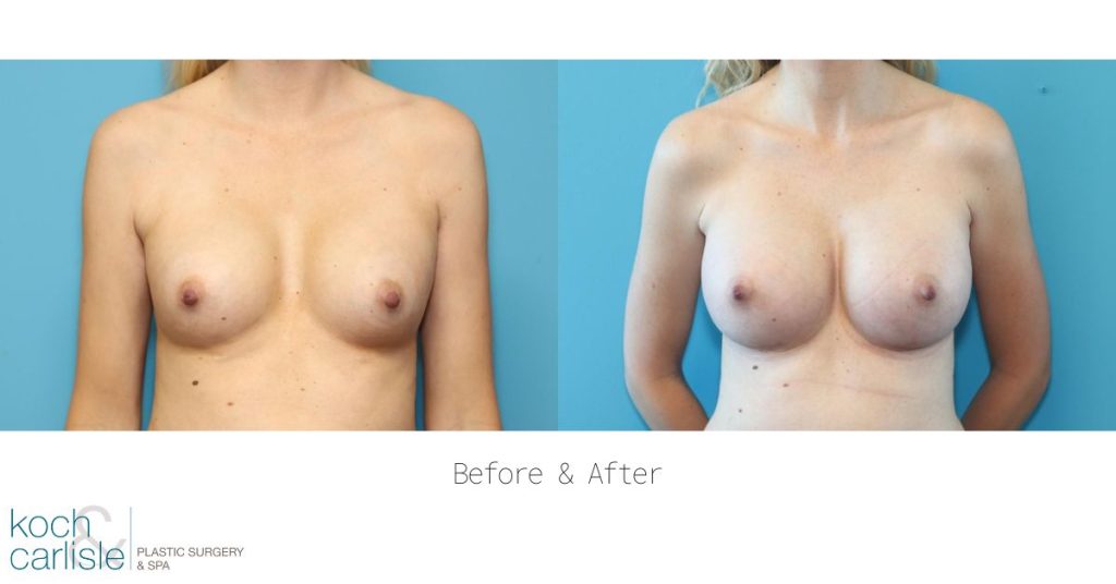 Actual patient before & after photos of breast augmentation (Koch & Carlisle logo)
