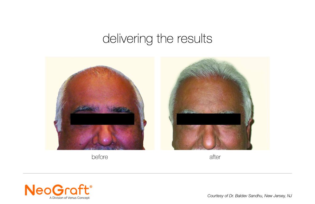Neograft Before and After