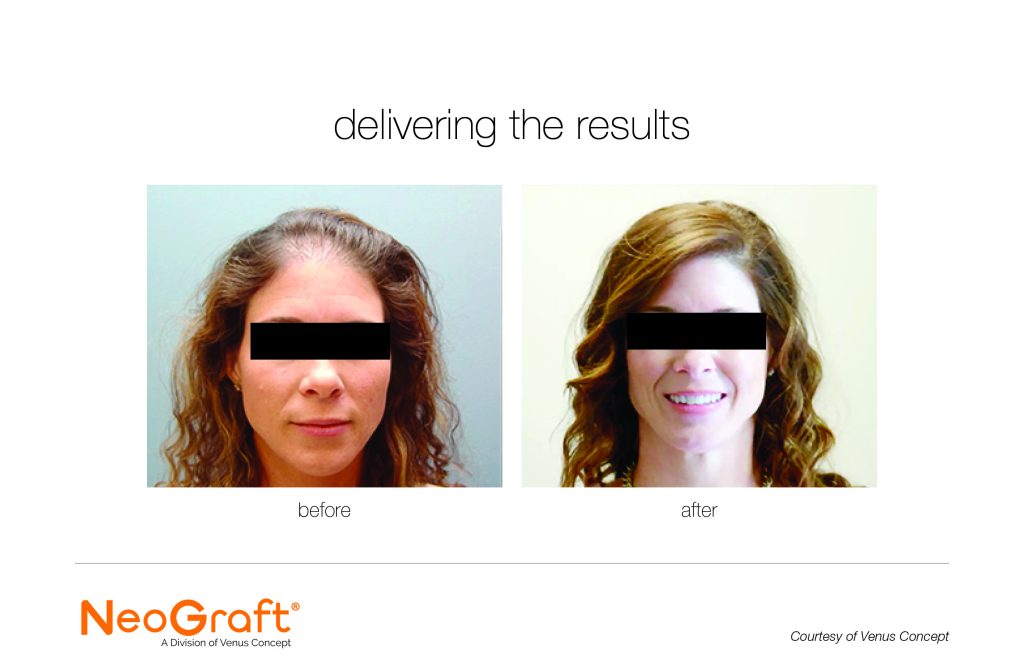 Neograft Before and After