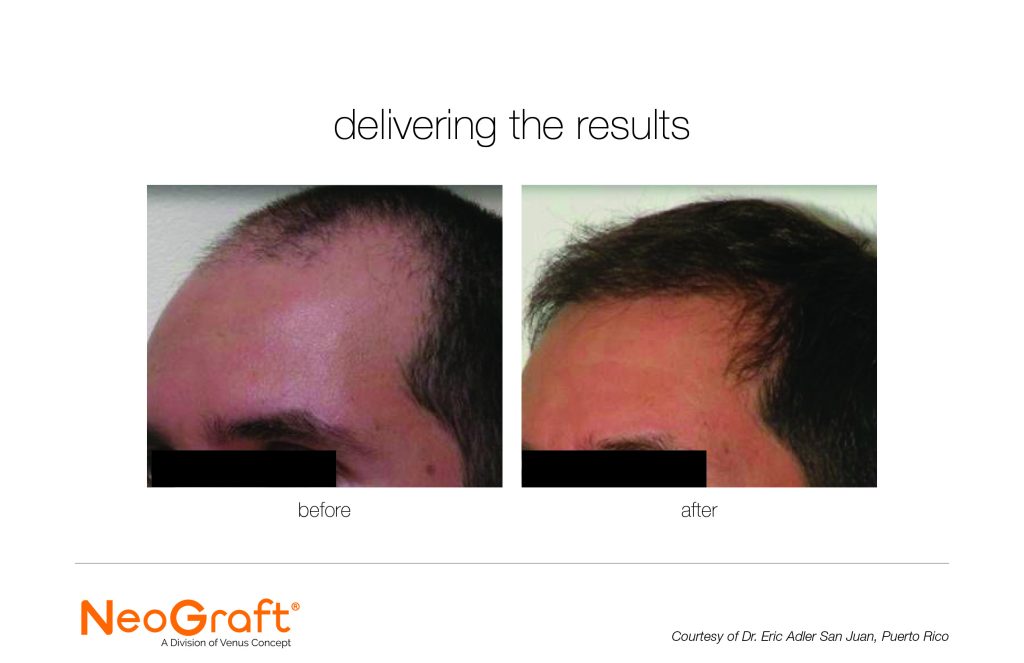 Neograft Before and After