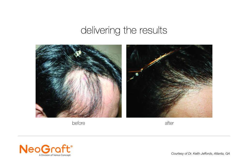 Neograft before and after