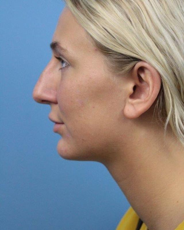 Checkout Alexa’s before and after #rhinoplasty photos in our story! You can see more #nosejob cases in our online gallery, link in bio.