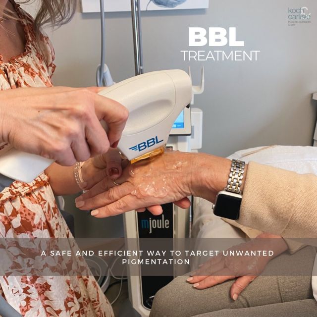 The BroadBand Light (BBL) is a fan-favorite laser at Koch & Carlisle Plastic Surgery!
 
This high-end laser is one of the most powerful and effective devices on the market. The BBL delivers light therapy directly to the skin to correct unwanted pigmentation due to age spots and sun damage.
 
With minimal downtime, this laser rejuvenates the skin, resulting in a younger, more even skin tone. 
 
Interested in learning more? Our estheticians are amazing at developing a plan specialized for your skin! Give us a call today for a complimentary consultation: 515-277-5555. 

.
.
.
.
.
@kandcplasticsurgery 
@drcarlisleplasticsurgery 
@sciton_inc