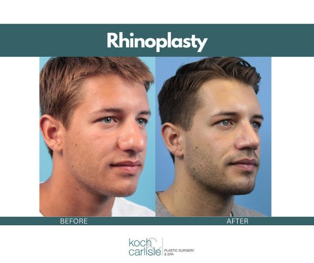 Take a look at the natural result created by Dr. Brent Koch following a rhinoplasty procedure -- stunning! 

As the most focal point of the face, a small adjustment to the nose can create proportionality and symmetry. A small change can truly make a difference! 

Have you considered making a change? The best place to start is by setting up a consultation to learn more about what the process may look like for you. 

Please give our office a call to learn more: 515-277-5555.

.
.
.
.
.
@kandcplasticsurgery 
@drcarlisleplasticsurgery 
#rhinoplasty #iowamedspa #iowaplasticsurgery #plasticsurgery #plasticsurgerybeforeandafter #medicalspa #desmoines
