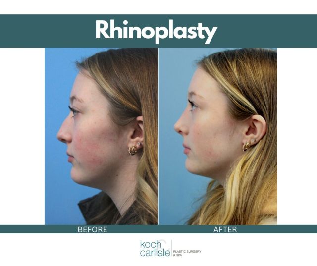 𝑭𝒓𝒐𝒎 𝒕𝒉𝒆 𝒑𝒂𝒕𝒊𝒆𝒏𝒕: "I LOVE IT! I would recommend Brent to anyone!"

As some of the top facial plastic surgeons in Iowa, our surgeons perform about 45 to 50 rhinoplasty procedures per year and have performed more rhinoplasty procedures than any other practice in the state. 

𝑫𝒖𝒓𝒊𝒏𝒈 𝒚𝒐𝒖𝒓 𝑹𝒉𝒊𝒏𝒐𝒑𝒍𝒂𝒔𝒕𝒚 𝒄𝒐𝒏𝒔𝒖𝒍𝒕𝒂𝒕𝒊𝒐𝒏, your doctor will: 

・Spend a great deal of time with you, discussing your goals, concerns, and physical and lifestyle considerations.
・Listen intently to your insights, opinions, and desires.
・Perform computer imaging to help you visualize your results.
・Work with you to develop the best approach to your treatment, as each nasal surgery is different and requires a unique plan.

If you're interested in setting up a rhinoplasty consultation with either Dr. Brent Koch or Dr. Cody Koch, we encourage you to give our office a call: 515-277-5555.