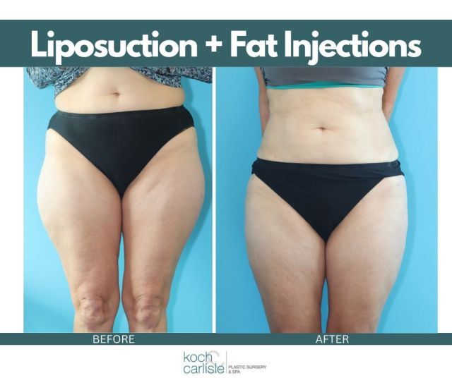 𝑳𝒐𝒗𝒆 𝒚𝒐𝒖𝒓 𝒔𝒊𝒍𝒉𝒐𝒖𝒆𝒕𝒕𝒆 👏

Dr. Carlisle's patient (58) received liposuction of the thighs, waist and lower back, along with fat injections to the hip dips. Fat injections to the hip dips can craft a smooth, shaped contour. 

You may be a good candidate for liposuction if you are a generally healthy nonsmoker who is at or near your goal weight. 

𝘐𝘵 𝘪𝘴 𝘪𝘮𝘱𝘰𝘳𝘵𝘢𝘯𝘵 𝘵𝘰 𝘯𝘰𝘵𝘦 𝘵𝘩𝘢𝘵 𝘭𝘪𝘱𝘰𝘴𝘶𝘤𝘵𝘪𝘰𝘯 𝘪𝘴 𝘯𝘰𝘵 𝘢 𝘸𝘦𝘪𝘨𝘩𝘵 𝘭𝘰𝘴𝘴 𝘵𝘳𝘦𝘢𝘵𝘮𝘦𝘯𝘵 𝘣𝘶𝘵 𝘳𝘢𝘵𝘩𝘦𝘳 𝘢 𝘤𝘰𝘮𝘱𝘭𝘦𝘮𝘦𝘯𝘵 𝘵𝘰 𝘢 𝘩𝘦𝘢𝘭𝘵𝘩𝘺 𝘭𝘪𝘧𝘦𝘴𝘵𝘺𝘭𝘦.

If you are interested in learning more, we encourage you to schedule a consultation with Dr. Carlisle: 515-277-5555.