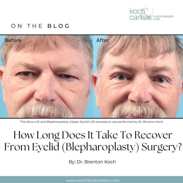 𝑶𝒏 𝒕𝒉𝒆 𝒃𝒍𝒐𝒈: "How Long Does It Take To Recover From Eyelid (Blepharoplasty) Surgery?"

Dr. Brenton Koch details the recovery process for eyelid surgery in a recent blog post on Koch & Carlisle's website:

"The downtime needed after eyelid surgery varies a bit from patient to patient, but most people say they start feeling like their usual selves within a few days of the surgery." 

The full post is available online: https://www.kochandcarlisle.com/blog/how-long-does-it-take-to-recover-from-eyelid-surgery/