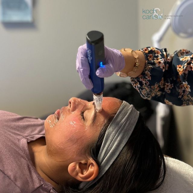 𝑻𝒉𝒆 𝑺𝒌𝒊𝒏𝑷𝒆𝒏 𝒎𝒊𝒄𝒓𝒐𝒏𝒆𝒆𝒅𝒍𝒊𝒏𝒈 𝒅𝒆𝒗𝒊𝒄𝒆 uses the body’s natural healing process to repair and tighten skin. 

Microneedling is used to treat the following skin conditions:
✔️Acne scars
✔️Wrinkles
✔️Fine lines
✔️Burn scars

"𝑯𝒐𝒘 𝒎𝒂𝒏𝒚 𝒕𝒓𝒆𝒂𝒕𝒎𝒆𝒏𝒕𝒔 𝒘𝒊𝒍𝒍 𝑰 𝒏𝒆𝒆𝒅?"
While the number of required treatments depends on skin condition and the aggressiveness of each treatment, most patients undergo 4 to 6 treatments for optimal results. (Numbing is required for this treatment.) 

"𝑾𝒉𝒂𝒕 𝒅𝒐𝒆𝒔 𝒕𝒉𝒆 𝒓𝒆𝒄𝒐𝒗𝒆𝒓𝒚 𝒑𝒓𝒐𝒄𝒆𝒔𝒔 𝒍𝒐𝒐𝒌 𝒍𝒊𝒌𝒆?"
 There is some redness after a SkinPen microneedling treatment and some swelling, but both side effects are less severe and dissipate after 2 days. Recovery following microneedling treatment is also less painful than after laser- or light-based therapy.

Interested in learning more? Give our office a call to schedule a complimentary skincare consultation: 515-277-5555.

.
.
.
.
.
@kandcplasticsurgery 
@drcarlisleplasticsurgery 
#microneedling #microneedlingtreatment #skinpen #skinpenmicroneedling #medicalspa #desmoines #skincaretips #acnescartreatment #burnscartreatment #iowamedspa