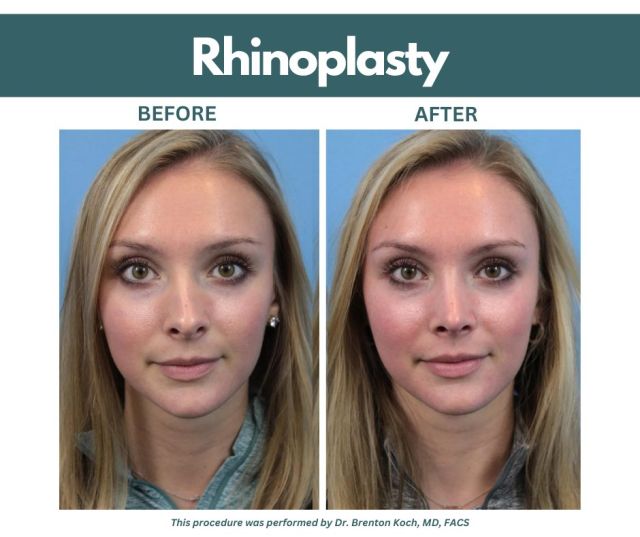 Swipe to see more from this beautiful rhinoplasty done by Dr. Brenton Koch!

As some of the top facial plastic surgeons in Iowa, our surgeons perform about 45 to 50 rhinoplasty procedures per year for our patients; they have performed more rhinoplasty procedures than any other practice in the state. 👍

Check out more of Dr. Koch's work by visiting our online Photo Gallery: https://www.kochandcarlisle.com/photo-gallery/

Consultations can be booked by calling our office: 515-277-5555.