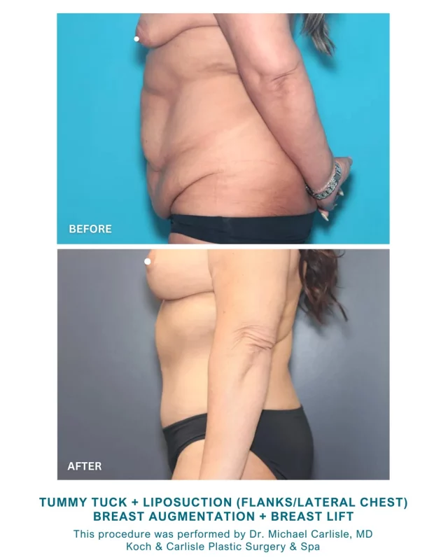Dr. Carlisle's patient said the final outcome of her surgery was "better than expected." 👏🙌

Our patient received a tummy tuck with liposuction to her flanks and lateral chest. She also received a breast augmentation with a breast lift. She is 3 months post-op in her "after" photos. 

From the patient: "I am very pleased with my results - final outcome is better than expected." .. We are so happy to hear it! ❤

Have you considered a tummy tuck or breast augmentation? Dr. Carlisle would love to meet with you for an in-person, in-depth consultation.

Check out more of Dr. Carlisle's work below, or schedule a consultation by visiting our website or calling our office:
➡ Request a consultation | https://www.kochandcarlisle.com/consultation-mobile/
➡ Check out more of Dr. Carlisle's work | https://www.kochandcarlisle.com/photo-
gallery/

Koch & Carlisle Plastic Surgery & Spa is located at 4855 Mills Civic Parkway in West Des Moines, Iowa. Consultations can be made by calling our office: 515-277-5555