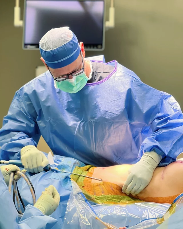 📸: Dr. Carlisle performing liposuction at West Lakes Surgery Center

During a liposuction procedure, our doctors use a tube called a cannula (pictured) to suction out stubborn fat and create more attractive contours. 

Liposuction can be performed on MANY areas of the body, and it's performed by all three of our plastic surgeons at Koch & Carlisle Plastic Surgery & Spa. 

Both Dr. Brent Koch and Dr. Cody Koch perform facial liposuction, and Dr. Carlisle performs liposuction on the abdomen, hips (flanks), thighs, and arms. 

Curious if you would be a candidate for liposuction? Good candidates for liposuction are generally healthy, non-smokers who are at or near their goal weight. (It is important to note that liposuction is not a weight loss treatment but rather a complement to a healthy lifestyle.)

If you are interested in learning more about liposuction procedures at Koch & Carlisle Plastic Surgery & Spa, we encourage you to schedule an in-person consultation:
➡ Inquire online | https://www.kochandcarlisle.com/consultation-mobile/
➡ Inquire over the phone | 515-277-5555, press "1" for our medical office

Koch & Carlisle Plastic Surgery & Spa is located at 4855 Mills Civic Parkway in West Des Moines, Iowa.