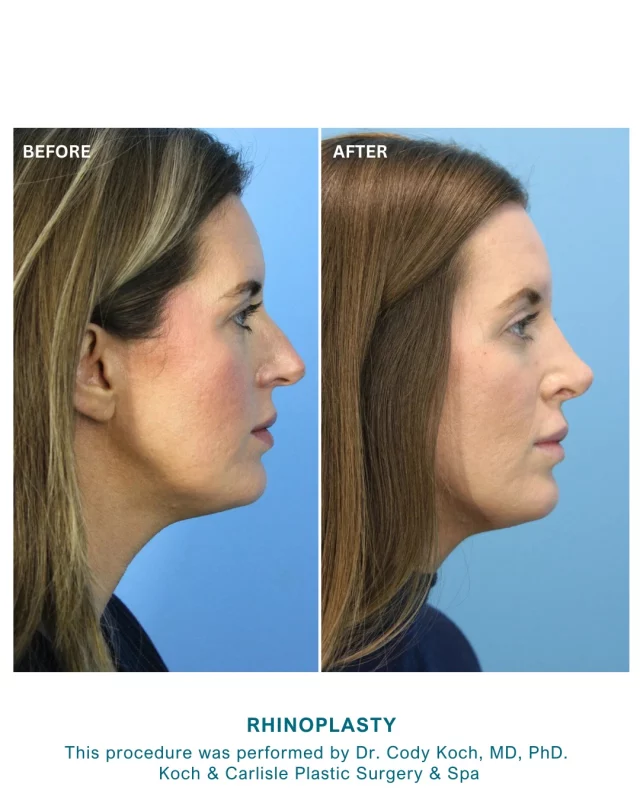 From our patient | How I feel about my results: "I love my outcome." 👏🙌

This Rhinoplasty procedure was performed by Dr. Cody Koch of Koch & Carlisle Plastic Surgery & Spa. 

Both Dr. Brent Koch and Dr. Cody Koch perform rhinoplasty at our practice to change the size or shape of your nose so it’s more attractive, or to restore optimal breathing function. 

As some of the top facial plastic surgeons in Iowa, our surgeons have performed thousands of rhinoplasty procedures for our patients; they have performed more rhinoplasty procedures than any other practice in the state.

Are you thinking about a Rhinoplasty procedure? Our doctors would love to meet with you for an in-person consultation:
➡ Inquire online | https://www.kochandcarlisle.com/consultation-mobile/
➡ 515-277-5555 | press "1" for our medical office

Koch & Carlisle Plastic Surgery & Spa is located at 4855 Mills Civic Parkway in West Des Moines, Iowa.