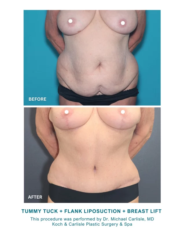 Absolutely gorgeous results created by Dr. Michael Carlisle, MD of Koch & Carlisle Plastic Surgery! 🙌

Our patient is a 73-year-old woman who sought surgical body contouring after achieving weight loss. She was interested in improving the appearance of her abdomen and flanks as part of her continued commitment to her personal wellness. 

From our Patient | How I feel about my results: "Excellent! Best thing I've ever done for myself."

She elected to undergo a tummy tuck, paired with flank liposuction and a breast lift. Her tailored procedure included an abdominoplasty, which removed excess skin and tightened the abdominal area, as well as strategic liposuction to contour the waistline. 

Dr. Michael Carlisle, MD is a board certified in both plastic surgery and otolaryngology, specializing in breast and body procedures. Dr. Carlisle combines surgical expertise and patient-focused care to achieve balanced, natural-looking outcomes.

Interested in learning more about this procedure? We are happy to assist or answer any questions you have! You can reach our office by calling our office or sending an online inquiry:
➡ 515-277-5555 | press "1" for our medical office
➡ https://www.kochandcarlisle.com/consultation-mobile/