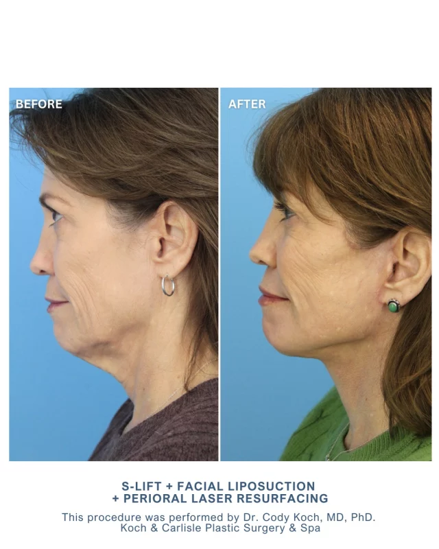 Our patient's personalized treatment included an S-Lift facelift, facial liposuction, and perioral laser resurfacing. 

From our Patient | How I feel about my results: "Great. Very happy."

The combination of procedures was performed by Dr. Cody Koch, MD, PhD, at Koch & Carlisle Plastic Surgery & Spa. This approach focused on redefining the jawline, smoothing skin texture, and reducing peri-oral lines. Throughout her recovery, our patient followed a dedicated postoperative care plan in order to support optimal healing and results.

Dr. Koch is board-certified in both facial plastic surgery and otolaryngology. Patients considering a facelift appreciate his experience and commitment to individualized care.

He combines advanced surgical techniques with a thoughtful, patient-centered approach.

Check out more of Dr. Koch's work by clicking on our Photo Gallery below:
➡ Photo Gallery | https://www.kochandcarlisle.com/photo-gallery/
➡ Request an Online Consultation: https://www.kochandcarlisle.com/consultation-mobile/