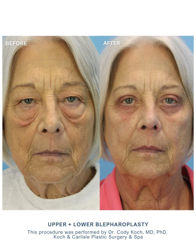 An absolutely stunning upper and lower blepharoplasty transformation by Dr. Cody Koch of Koch & Carlisle Plastic Surgery. 

Our patient is one month post-operative in her "after" photos. 👏

The patient’s experience was smooth, and her recovery progressed as expected. She expressed satisfaction with the process, noting that she was “seeing better” and described her results as “awesome.” These improvements are evident in her before and after photos, where a brighter, more rejuvenated eye area is visible.

Eyelid Surgery (Lower, Under Eyes) can offer both aesthetic and functional benefits, as seen in this case. By removing excess tissue from both the upper and lower eyelids, patients often experience improved comfort and self-confidence.

Dr. Cody Koch, MD, PhD, board-certified in both Facial Plastic and Reconstructive Surgery and Otolaryngology-Head and Neck Surgery, performed this surgery with a focus on natural-looking results. His advanced training and commitment to patient-centered care contribute to outcomes that align closely with patient goals. 

To see more of Dr. Koch's work, head on over to our photo gallery:
➡ https://www.kochandcarlisle.com/photo-gallery/