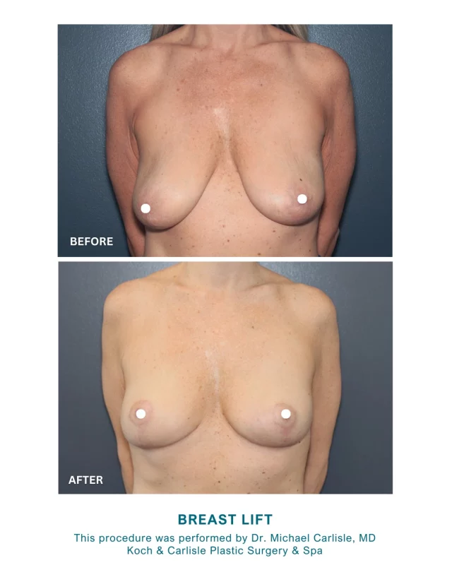 From the Patient | How I feel about my results: "Very happy! Better than expected! Truly like a different person!"

Our patient underwent the procedure as an elective surgery with Dr. Michael Carlisle at Koch & Carlisle Plastic Surgery & Spa. The before and after photos above reflect the improved breast shape and position post-surgery, in line with her personal goals.

Dr. Carlisle is a board-certified plastic surgeon who specializes in breast and body procedures at Koch & Carlisle Plastic Surgery & Spa. Patients often appreciate his detailed explanations, skilled technique, and commitment to individualized care.

To see more of Dr. Carlisle's work, head on over to our online photo gallery:
➡ https://www.kochandcarlisle.com/photo-gallery/

Interested in meeting with Dr. Carlisle for an in-person consultation? We're happy to help assist you in this process:
➡ 515-277-5555 | press "1" for our medical office
➡ Inquire online | https://www.kochandcarlisle.com/consultation-mobile/