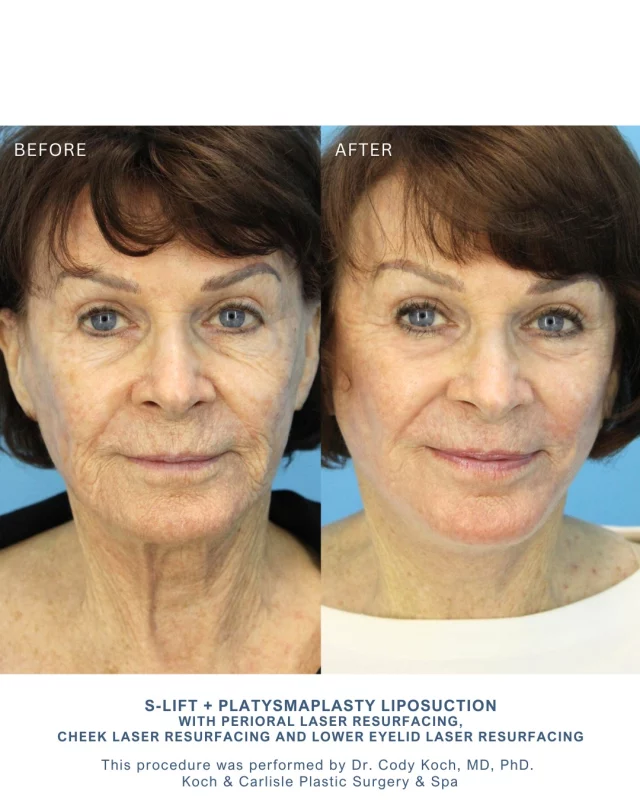 Our patient sought treatment for age-related changes in her face and neck. She elected to undergo an S-Lift, targeted neck liposuction, and laser resurfacing of the perioral area, cheeks and lower eyelids.

Her case highlights the versatility of combining facelift procedures with advanced resurfacing and contouring techniques for those pursuing a facelift. Integrating these modalities can yield natural and noticeable improvements in facial contour and skin quality.

She is loving her results! 👏🩵

These results were achieved under the care of Dr. Cody Koch, MD, PhD of Koch & Carlisle Plastic Surgery & Spa. 

To see more of Dr. Koch's work or schedule an in-person consultation, click on the links below:
➡ Photo Gallery | https://www.kochandcarlisle.com/photo-gallery/
➡ Request a consultation | https://www.kochandcarlisle.com/consultation-mobile/
➡ Speak with a member of our team | 515-277-5555
