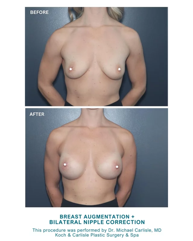 Our patient, 36, sought Breast Augmentation at Koch & Carlisle Plastic Surgery & Spa to enhance her breast shape and address concerns about inverted nipples. After thoughtful research and consultation, she opted to undergo bilateral breast augmentation with 345cc silicone implants, combined with bilateral inverted nipple correction. Her goals included improving breast contour and symmetry, as well as feeling more comfortable in fitted clothing.

Our patient expressed satisfaction with her results and overall experience, reflected by her comment, “10/10 recommend Dr. Carlisle.” Post-operative visits showed well-healed incisions, restored nipple appearance, and a natural-appearing breast contour that met her expectations.

Patients considering Breast Augmentation often seek individualized results that align with their lifestyle and goals. Dr. Michael Carlisle, MD, brings specialized training and board certification in both plastic surgery and otolaryngology. 

Dr. Carlisle emphasizes patient safety, education, and natural outcomes, helping each individual reach their aesthetic goals with evidence-based techniques.

Interested in meeting with Dr. Carlisle for an in-person consultation? We would be happy to assist! 
➡ Click the link in our bio to inquire online
➡ Speak with a member of our team | 515-277-5555