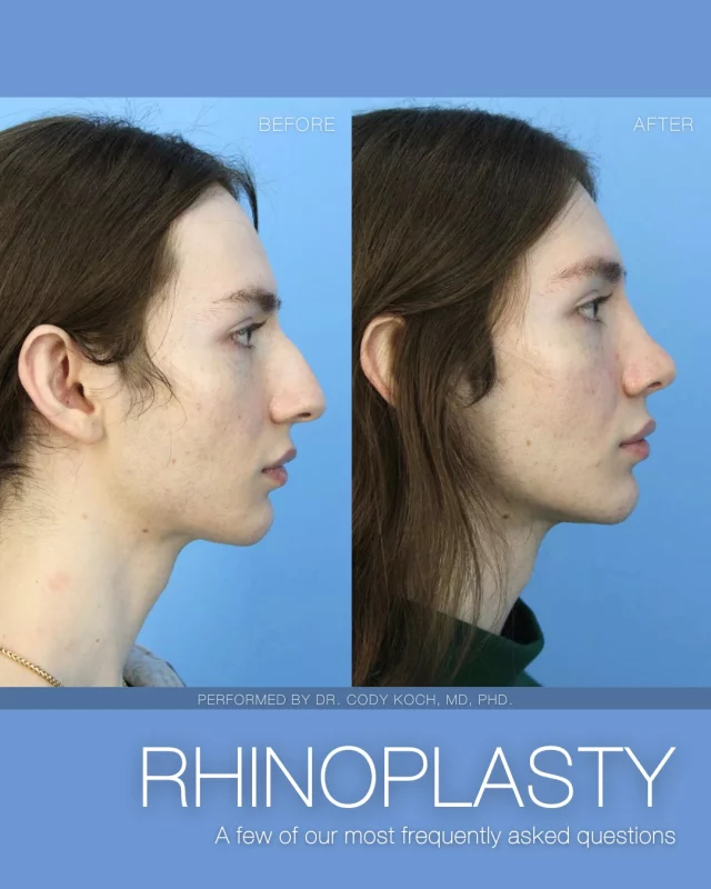 We explore a few of our most frequently asked questions regarding our popular Rhinoplasty procedure, performed by our board-certified, facial plastic surgeons: Dr. Brent Koch and Dr. Cody Koch.

Through cosmetic rhinoplasty, the appearance of the nose can be altered by:
🩵Reducing a nasal hump
🩵Changing the shape of the tip or bridge
🩵Raising or lowering the tip
🩵Narrowing the span of the nostrils
🩵Cosmetic rhinoplasty creates a more proportional, harmonious nose while honoring your face’s unique aesthetic integrity.

Both Dr. Brent Koch and Dr. Cody Koch are accepting new patients interested in learning more about our Rhinoplasty procedure. Interested in learning more?
➡ Click the link in our bio to inquire online
➡ Call our office to reach out to a member of our team: 515-277-5555