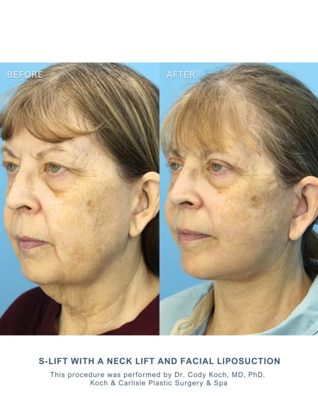 Our patient, 65, received an S-lift, a neck lift and facial liposuction by Dr. Cody Koch, our board-certified plastic surgeon and facial specialist at Koch & Carlisle Plastic Surgery. 

Our patient noted that "(Dr. Cody Koch) and staff were flexible and attentive to my needs and concerns" following her procedure. She is happy with her results! 👏🩵

Dr. Cody Koch, MD, PhD draws on specialized training in facial plastic and reconstructive surgery and maintains board certification in two surgical specialties. 

His care approach focuses on individualized plans and supporting patients at every stage, providing expertise in facelift outcomes for those seeking a facelift. 

Interested in meeting with Dr. Koch for an in-person consultation? Click on the link in our bio to inquire online, or reach out to speak with a member of our team:
➡ 515-277-5555 | press "1" to schedule a consultation