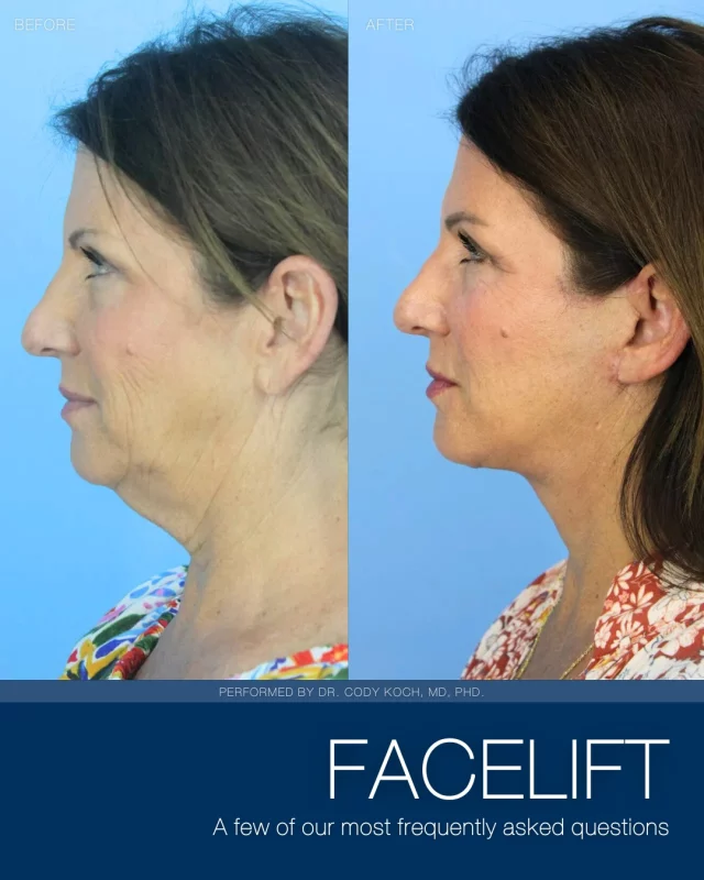 We explore a few of our most frequently asked questions regarding our popular Rhinoplasty procedure, performed by our board-certified, facial plastic surgeons: Dr. Brent Koch and Dr. Cody Koch.

A mini facelift (or S-Lift as we call it), one of our most commonly performed procedures, can provide a remarkable improvement in your appearance. Facelift surgery may be the ideal procedure for you if you wish to achieve any of the following:
🩵Decrease premature wrinkles
🩵Increase skin elasticity
🩵Improve overall appearance

Both Dr. Brent Koch and Dr. Cody Koch are accepting new patients interested in learning more about our Rhinoplasty procedure. Interested in learning more?
➡ Click the link in our bio to inquire online
➡ Call our office to reach out to a member of our team: 515-277-5555