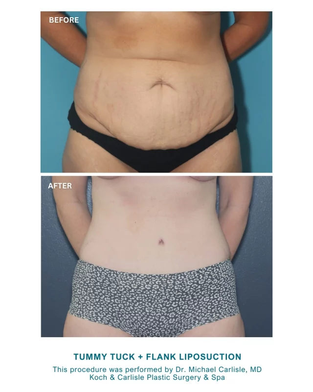 Our patient, 38, wanted to address concerns with loose abdominal skin and persistent fat along her flanks. She opted for a tummy tuck combined with liposuction to her flanks.

Her “after” photos are 4 months post-procedure! 👏

Following surgery, our patient reported feeling “amazing” and expressed that she was very happy with how everything turned out. The before and after images reflect the improvements to her abdominal contour and flank area. 

Dr. Michael Carlisle, MD performed all of these procedures. He is a board-certified plastic surgeon and body specialist at Koch & Carlisle Plastic Surgery & Spa. Dr. Carlisle draws on extensive training at the Cleveland Clinic and other renowned institutions, providing thorough explanations and individualized plans for each patient he treats.

Interested in meeting with Dr. Carlisle for an in-person consultation? We would be happy to help:
➡ Request a Consult | https://www.kochandcarlisle.com/consultation-mobile/
➡ Speak with a member of our team | 515-277-5555, press "1" for consultations