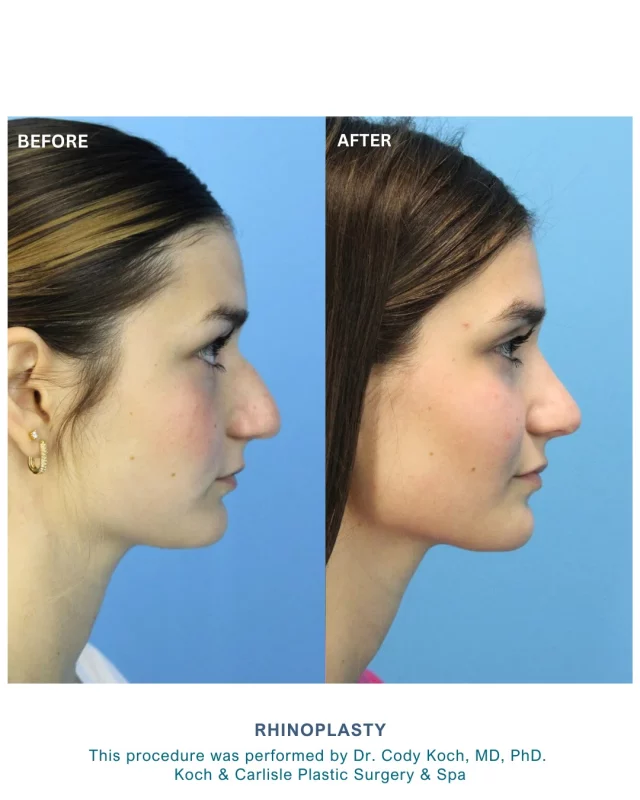 Following her rhinoplasty procedure with Dr. Cody Koch, our patient said she “loves the results so much,” and it’s “exactly” what she wanted.

We’re thrilled to hear she loves her gorgeous results! 👏

This procedure is performed by our board-certified plastic surgeons, Dr. Brent Koch and Dr. Cody Koch, who specialize in face and neck surgeries at Koch & Carlisle Plastic Surgery.

As some of the top facial plastic surgeons in Iowa, our surgeons have performed thousands of rhinoplasty procedures for our patients.

Interested in meeting with our doctors for an in-person consultation? We are happy to help!
➡ Speak with a member of our team | 515-277-5555, press "1" for consultations
➡ Inquire online | https://www.kochandcarlisle.com/consultation-mobile/