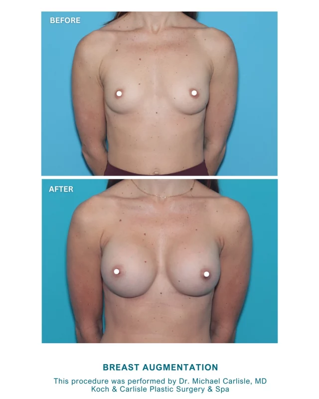 Check out our patient's gorgeous transformation following her Breast Augmentation by our Dr. Michael Carlisle, our breast and body specialist, and board-certified plastic surgeon of Koch & Carlisle Plastic Surgery & Spa. 

In this specific case, our patient received gummy bear implants: 325cc on her left and 385cc on her right.

Dr. Carlisle is dual board certified by the American Board of Plastic Surgery and the American Board of Otolaryngology - Head and Neck Surgery. He brings extensive training from institutions such as Wayne State University and the Cleveland Clinic.

Patients choose him for his commitment to clear communication, his knowledge of breast and body procedures, and the specialized care available at Koch & Carlisle Plastic Surgery & Spa. 

Interested in scheduling an in-person consultation with Dr. Carlisle? We would love to help! 
➡ Speak with a member of our team | 515-277-5555, press "1" for consultations
➡ Inquire online | https://www.kochandcarlisle.com/consultation-mobile/
