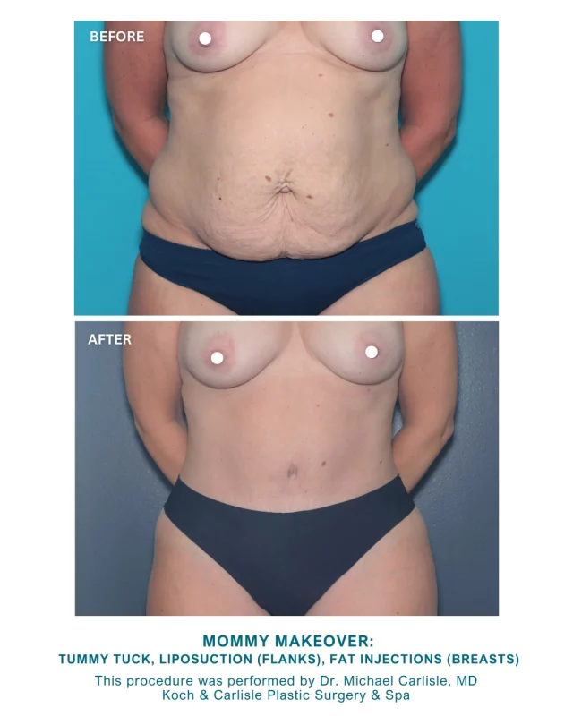 Swipe through to see the results of a custom Mommy Makeover by Dr. Carlisle!

Our patient is a mother in her 40s who was interested in creating a more balanced silhouette.

Her customized Mommy Makeover procedure included a tummy tuck, liposuction to her flanks (waist), and fat injections (transfer) to her breasts. As a result of the fat injections, our patient's cup size slightly increased, resulting in fuller, more proportioned breasts.

Dr. Michael Carlisle, MD, is a board-certified plastic surgeon and body specialist at Koch & Carlisle Plastic Surgery & Spa. Dr. Carlisle draws on extensive training at the Cleveland Clinic and other renowned institutions, providing thorough explanations and individualized plans for each patient he treats.

Interested in meeting with Dr. Carlisle for an in-person consultation? We would love to get you started!
➡ Speak with a member of our team | 515-277-5555
➡ Inquire online | https://www.kochandcarlisle.com/consultation-mobile/
