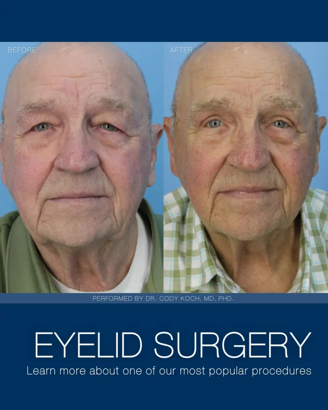 Blepharoplasty, or eyelid surgery, is one of the most common procedures performed by both Dr. Brenton Koch and Dr. Cody Koch. While it is often a relatively quick procedure, its impact is immediate! 

Eyelid surgery addresses the sagging and bags that develop with age, helping patients achieve a refreshed yet natural appearance.

Our patients are consistently amazed by their results! 🩵👏

Swipe over to learn more about this procedure, or visit our website to check out more results found on our "Before & After" photo gallery:
➡ Before & After | https://www.kochandcarlisle.com/photo-gallery/