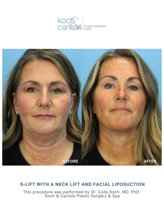 Our patient, 55, chose to undergo an S-Lift and neck lift, combined with facial liposuction.

Our patient's experience included an S-Lift technique to address sagging skin, combined with facial liposuction for improved contour and a neck lift for added definition. She reported feeling cared for throughout her care journey, stating she felt “so excited” about her results and appreciated that “everyone was super sweet and took great care” of her.

Her before-and-after photos reflect subtle but effective improvements to her facial contours and neck. 

Dr. Cody Koch, MD, PhD, performed this procedure. He is board certified in both facial plastic and reconstructive surgery and otolaryngology–head and neck surgery. Dr. Koch draws on advanced training and a commitment to natural results for his patients at Koch & Carlisle Plastic Surgery & Spa. 

Interested in meeting with Dr. Cody Koch for an in-person consultation? We would love to help!
➡ Speak with a member of our team | 515-277-5555, press "1" for consultations
➡ Inquire online | https://www.kochandcarlisle.com/consultation-mobile/