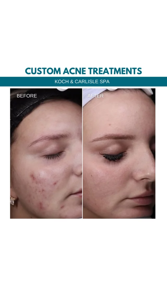 Looking in the mirror and seeing a reflection without acne is freeing, according to our spa patient, Nicole.

Nicole’s skincare plan has included a combination of laser treatments and, more recently, a new acne protocol—incorporating lifestyle adjustments, supplements, and a customized ongoing treatment plan.

Stay tuned—our announcement comes Thursday, Sept. 4.

.
.
.
.
#acne #acnetreatment #acnefreeskin #acnesolution #westdesmoines #kochandcarlisleplasticsurgery #kochandcarlislespa