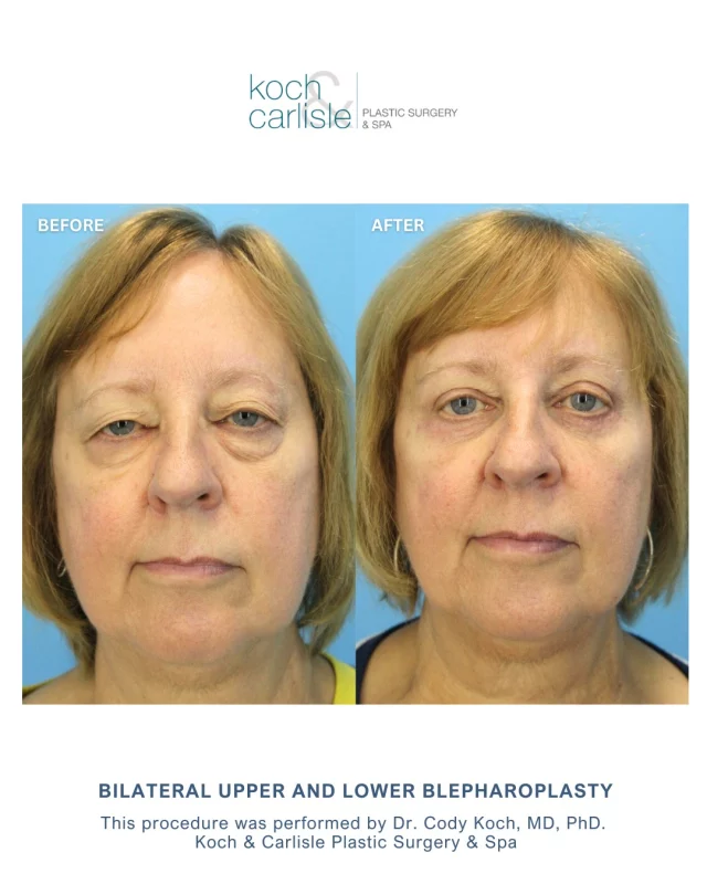 A gorgeous transformation by Dr. Cody Koch!

Our patient, 71, received a bilateral upper and lower blepharoplasty (eyelid lift) by Dr. Cody Koch of Koch & Carlisle Plastic Surgery & Spa. 

Eyelid Surgery is designed to address functional and cosmetic concerns for adult patients. Our patient's experience highlights the careful planning and surgical expertise applied to each case. Dr. Koch takes a detailed, individualized approach and is dedicated to achieving results that best support each patient’s goals and lifestyle.

Following her procedure, she reported being very pleased with the results. Her photos show reduced excess skin above the eyes and less puffiness in the lower lids. She now enjoys an overall brighter and more alert look.

Check out our online photo gallery to see more of Dr. Koch's work:
🔗 https://www.kochandcarlisle.com/photo-gallery/

#eyelidsurgery #blepharoplasty #kochandcarlisleplasticsurgery #beforeandafter