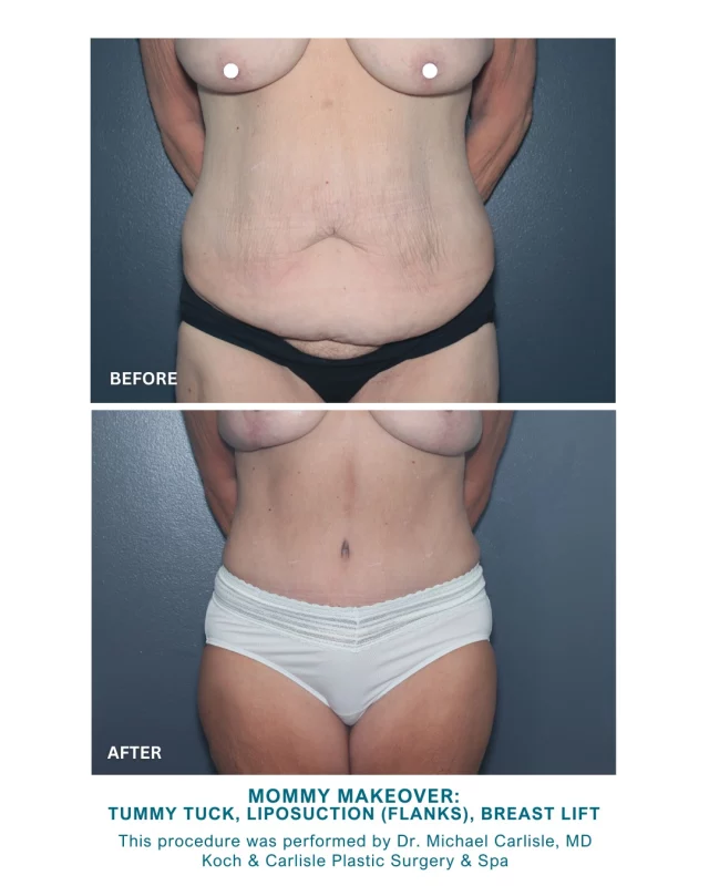 Our patient, 60, received a custom Mommy Makeover by Dr. Michael Carlisle, MD. Her procedures included a Tummy Tuck with Bilateral Liposuction to her Flanks, as well as a Breast Lift. Swipe over to see more!

From our Patient: "I feel so great; couldn't be happier! I love my new body!"

Dr. Carlisle is a board-certified plastic surgeon who specializes in the breast and body at Koch & Carlisle Plastic Surgery & Spa in West Des Moines. 

Following a Mommy Makeover, most of our patients return to work within 2 to 3 weeks post-procedure. Our Mommy Makeover patients are able to resume gradual exercise 4-6 weeks after surgery. Swelling will continue to subside over the next few months, and scars will fade to thin, light lines. 

We offer scar reduction therapies to help your scars appear as inconspicuous as possible.

Interested in meeting with Dr. Carlisle for an in-person consultation? We're happy to help!
➡ Speak with a member of our team | 515-277-5555, press "1" for consultations
➡ Inquire online | https://www.kochandcarlisle.com/consultation-mobile/