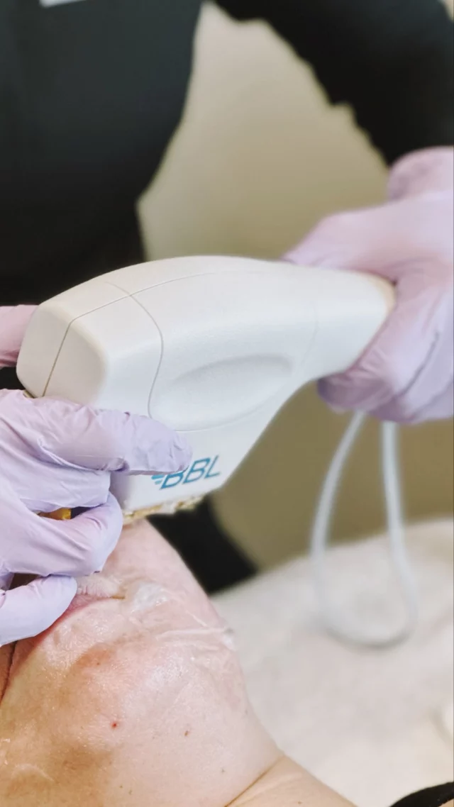 Imagine looking back at your wedding photos and feeling confident in your skin decades later. That’s the power of the BBL laser treatment. ⚡️

Our clinical aesthetician Ellen shares a recent conversation she had with a patient who felt her sunspots would never go away. Now, after receiving a customized BBL treatment, her patient wishes she would have done it sooner. 

From sun damage to brown spots, redness, and even skin laxity, BBL delivers real results with little downtown. 

Check out our video to learn more and take $50 off your laser treatment when you join our mobile app! 🙌