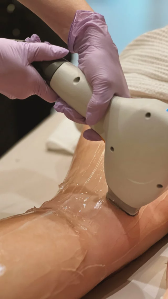 Tired of shaving? Us too. 

Ditch the razor as soon as 4-6 weeks after your first laser hair reduction treatment.

Laser hair reduction can be treated on many areas of the body including the face, chin, neck, underarms, arms, legs, and more. 

Save 20% off a laser hair reduction package when you purchase (6) treatments.

Interested in learning more? We’re here to help.
Schedule a complimentary skincare consultation: 515-277-5555, press “2” for our spa
Inquire online | https://www.kochandcarlisle.com/consultation-mobile/

#westdesmoines #kochandcarlisleplasticsurgery #medicalspa #medicalsparesults #westdesmoinesspa #kochandcarlisle #laserhairremoval #laserhairremovaltreatment #skinconfidence #hairfree
