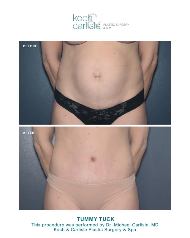 Our patient, a 42-year-old mother, sought a tummy tuck to restore her abdominal contour following changes from pregnancy and weight fluctuations over the years. Her primary goals were to address excess skin and achieve a smoother, firmer midsection. 

Her "after" photos were taken 3 months post-procedure. 🩵

She underwent her procedure with board-certified plastic surgeon, Dr. Michael Carlisle, MD of Koch & Carlisle Plastic Surgery. Recovery included an initial phase of downtime and gradual return to normal activity. 

Over the following weeks, swelling diminished, and she noticed improved waist definition and a flatter abdominal profile. 

For patients considering a Tummy Tuck, Dr. Carlisle combines clinical expertise with individualized care. Patients appreciate his clear communication and attention to detail throughout the surgical process.

Interested in meeting with Dr. Carlisle for an in-person consultation? We would love to help!
🔗 Inquire online | https://www.kochandcarlisle.com/consultation-mobile/
🩵 Speak with a member of our team | 515-277-5555, press "1" for consultations

#tummytuck #tummytucksurgery #boardcertified #boardcertifiedplasticsurgeon #westdesmoines #westdesmoinesiowa #mommymakeoversurgery #beforeandafter