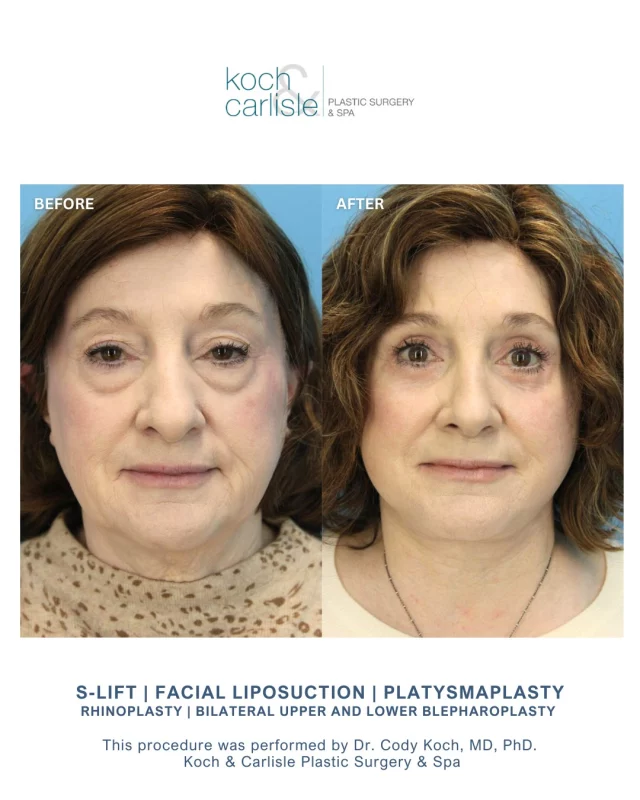 Our patient is so happy with her results following her life-changing surgery with Dr. Cody Koch of Koch & Carlisle Plastic Surgery. 

Her customized procedure included an S-Lift with facial liposuction and a platysmaplasty (neck lift), paired with a rhinoplasty and a bilateral upper and lower blepharoplasty. 

As a board-certified plastic surgeon, Dr. Koch exclusively performs facial plastic surgery at Koch & Carlisle Plastic Surgery & Spa in West Des Moines, Iowa. His specialties include facelift surgery, facial liposuction, eyelid lifts (upper and lower), rhinoplasty, and skin cancer reconstruction. 

Outside of his surgical skill, Dr. Koch's caring demeanor and personalized approach are routinely recognized by our patients. 

A recent review shared by our patient: 
"Dr. Koch and his staff are wonderful. It is a happy place to get help when needed. Dr. Koch has gone over and beyond what most doctors would do for a patient. I have nothing but good to say about him, and thank him for all that he has done for me following the infection I got after surgery. God bless each one of you."

Curious about facial plastic surgery? We would be happy to get you set up for an in-person consultation with Dr. Cody Koch. 
🔗 Inquire online | https://www.kochandcarlisle.com/consultation-mobile/
🩵 Speak with a member of our team | 515-277-5555, press "1" for consultations

:
:
:
:
:
#facelift #facialrejuvenation #facialsurgery #rhinoplastyresults #blepharoplasty #eyelidlift #faceliftresults #facialplasticsurgery #kochandcarlisleplasticsurgery #kochandcarlisle #westdesmoines #westdesmoinesiowa #boardcertifiedplasticsurgeon #boardcertified