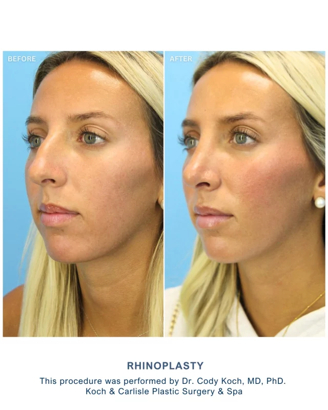Our patient, 21, sought rhinoplasty to address personal aesthetic concerns and achieve a balanced facial profile. Her experience was positive throughout the process. 👏

After her rhinoplasty with Dr. Cody Koch, MD, PhD of Koch & Carlisle Plastic Surgery, she appreciated clear communication and thoughtful guidance at every step. She felt comfortable discussing her goals and expectations prior to surgery.

Our patient is happy with her results following her procedure. She reports, “I love my nose. Exactly what I wanted.” 

Her outcome demonstrates how skillful rhinoplasty can fulfill a patient’s personal vision while preserving harmony with their natural facial structure. 🩵

Dr. Cody Koch, MD, PhD, performed this rhinoplasty. Dr. Koch is board-certified in Facial Plastic and Reconstructive Surgery, and Otolaryngology-Head and Neck Surgery. 

His experience and careful approach to rhinoplasty help patients achieve individualized results in line with their goals.

Interested in meeting with Dr. Koch for an in-person consultation? We would love to get you started!
🩵 Speak with a member of our team | 515-277-5555, press "1" for consultations
💻 Inquire online | https://www.kochandcarlisle.com/consultation-mobile/

.
.
.
.
.
#kochandcarlisleplasticsurgery #boardcertified #boardcertifiedplasticsurgeon #facialplasticsurgery #rhinoplasty #rhinoplastybeforeandafter #westdesmoines #westdesmoinesiowa