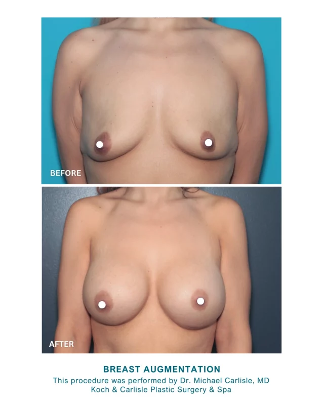 Breast Augmentation continues to be a safe, customizable option for women seeking changes to their breast contour. 

Our patient, 30, chose to undergo breast augmentation to achieve fuller, more balanced contours that would better align with her personal goals and body image. She wanted a significant, yet natural enhancement to her breast profile. 

For her procedure, she received 560cc gummy silicone implants placed by Dr. Michael Carlisle, MD. Recovery was smooth, and she quickly noticed the improvement in volume and shape. In follow-up visits, she expressed high satisfaction, stating, "I could not be happier with my results!" The results are evident in her before and after photos, which show a proportional and natural-looking outcome.

Dr. Carlisle's approach focuses on understanding each patient's goals and providing thorough information throughout the process. Dr. Carlisle offers advanced techniques and a personalized care experience to patients considering breast augmentation and similar procedures.

Interested in meeting with Dr. Carlisle for an in-person consultation? We would love to assist:
🩵 Speak with a member of our team | 515-277-5555, press "1" for consults
💻 Inquire online | https://www.kochandcarlisle.com/consultation-mobile/

.
.
.
#breastaug #breastaugmentation #kochandcarlisleplasticsurgery #westdesmoines #boardcertifiedplasticsurgeon #boardcertified #breastimplants #beforeandaftersurgery